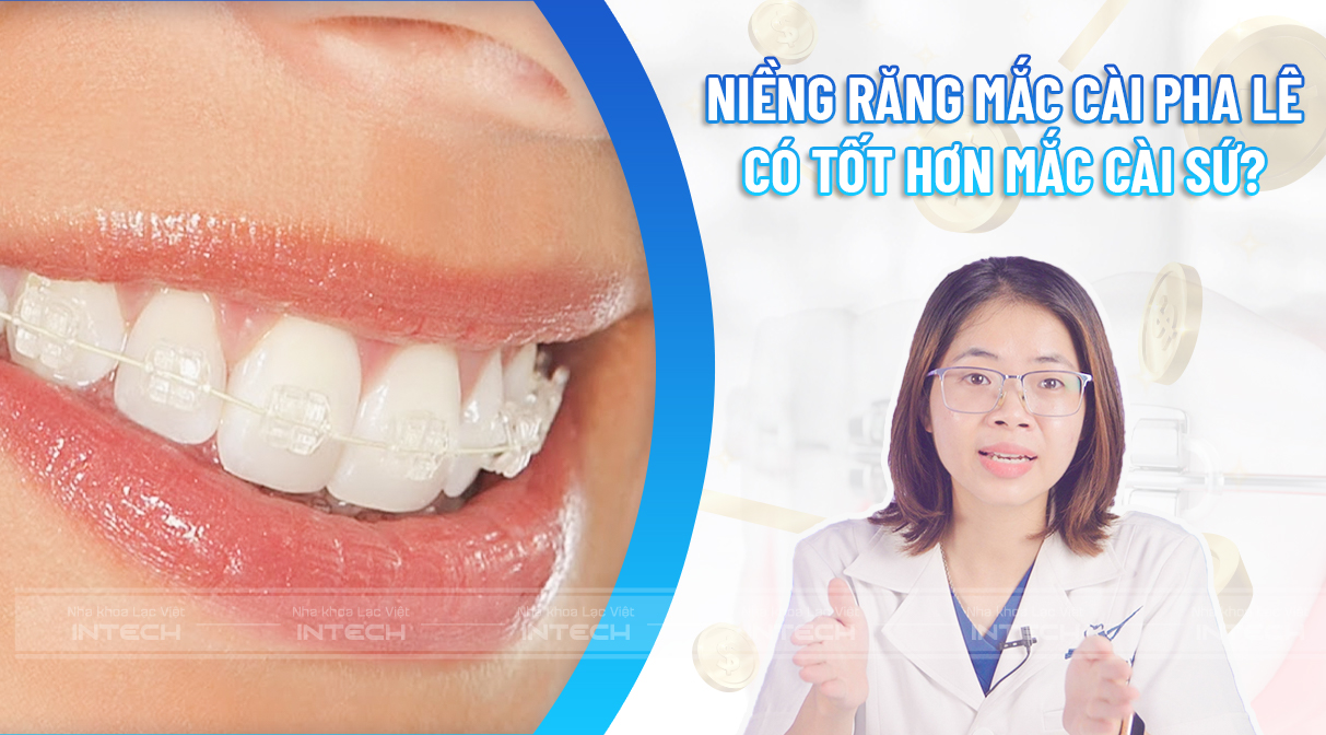 Niềng răng mắc cài pha lê giá bao nhiêu? Có tốt hơn so với mắc cài sứ?