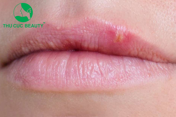 Phun môi bị nổi mụn trắng - Thu Cúc Sài Gòn