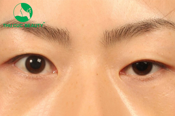 Sụp mí mắt: Nguyên nhân & cách khắc phục - Thẩm mỹ Thu Cúc
