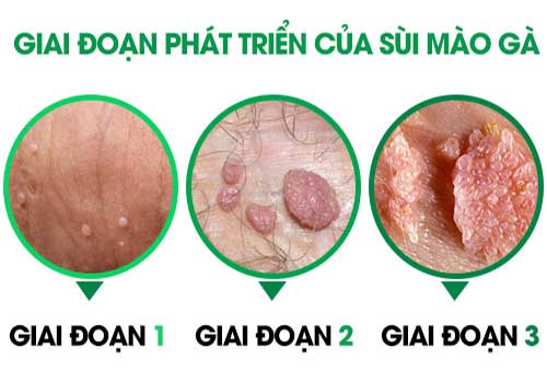 Điều trị bệnh sùi mào gà giai đoạn đầu