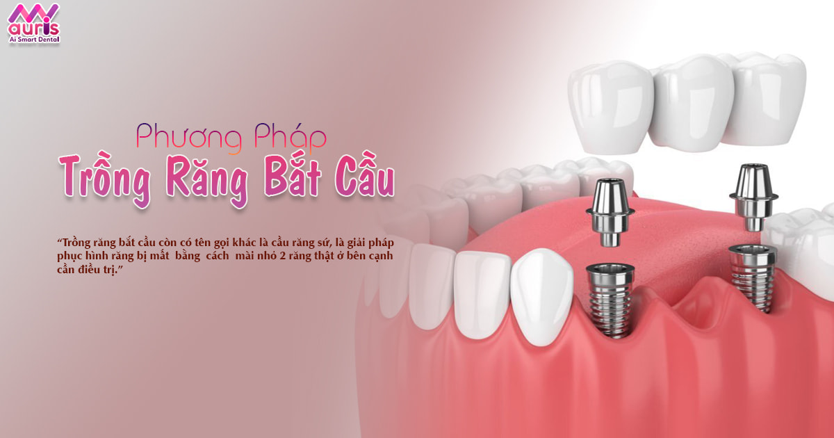 Phương pháp trồng răng bắt cầu là gì? Quy trình thực hiện - Nha Khoa My Auris