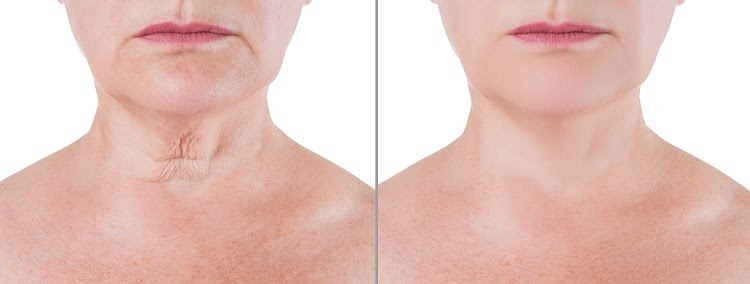 The Secret to a Younger-Looking Face: Facelift Surgery in Turkey