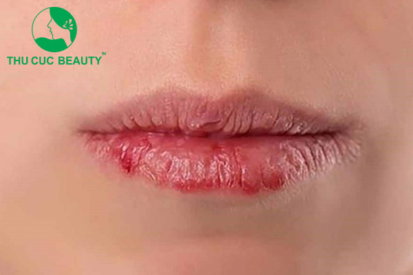 Tác hại của xăm môi - Thu Cúc Sài Gòn