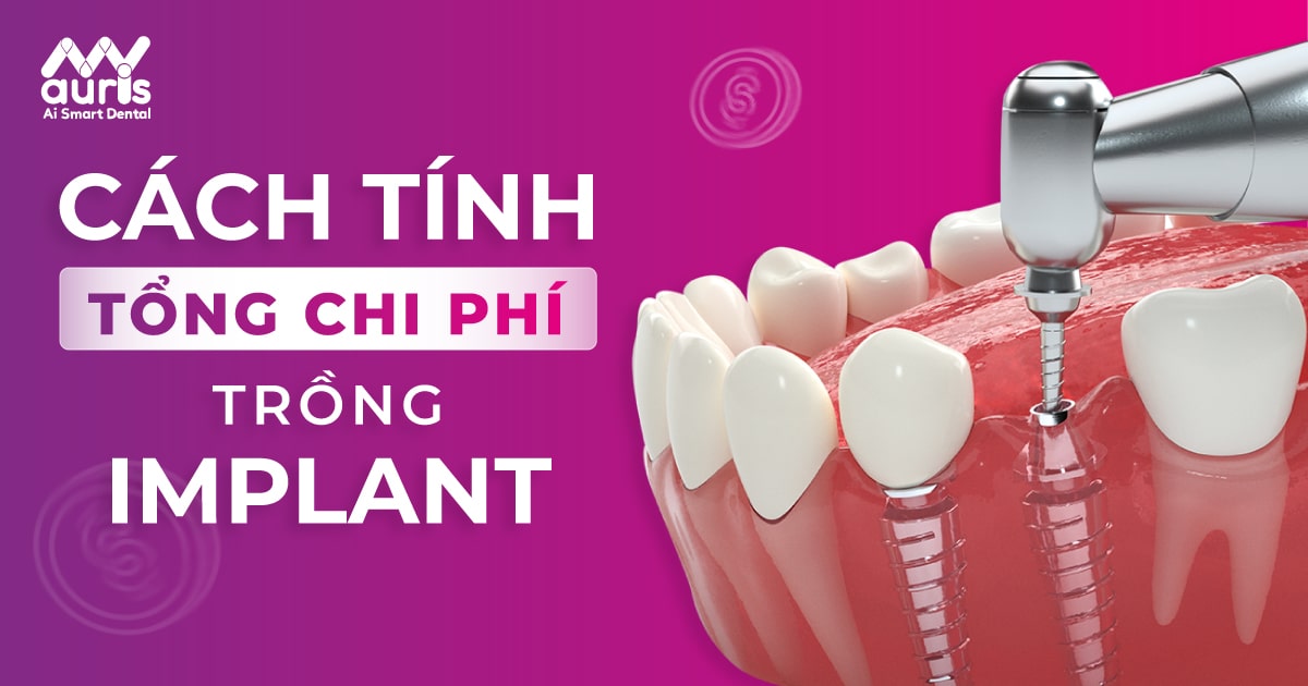 Tổng chi phí trồng răng implant tại nha khoa My Auris? - Nha Khoa My Auris