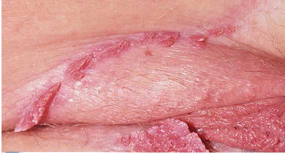 Bệnh sùi mào gà giai đoạn 1 có tự hết được không