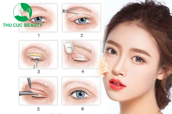 Cắt mí nội soi là gì? Ưu điểm vượt trội & chi phí thực hiện