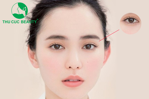 Cắt mí mắt giọt lệ Trung Hoa - Thẩm mỹ Thu Cúc