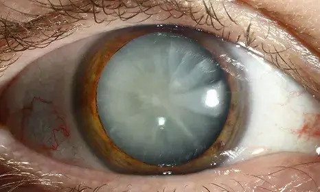 Best Cataract Surgery in Melbourne | Australia | City Eye Surgeons