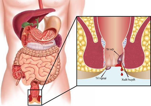 Phòng khám chữa bệnh trĩ ở quận 1