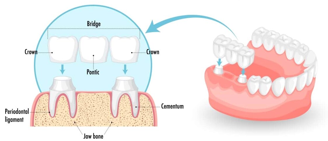 Dental Crown Bridge Treatment in Jalandhar