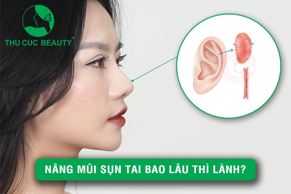 Nâng mũi sụn tai bao lâu thì lành? - Thu Cúc Sài Gòn