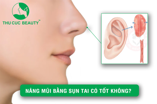 Nâng mũi bằng sụn tai có tốt không? - Thu Cúc Sài Gòn