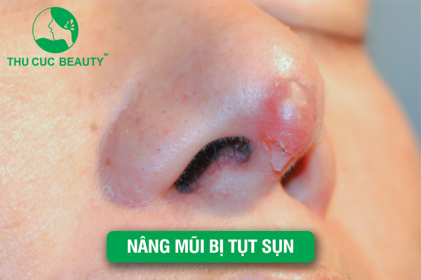Nâng mũi bị tụt sụn - Nguyên nhân và cách khắc phục