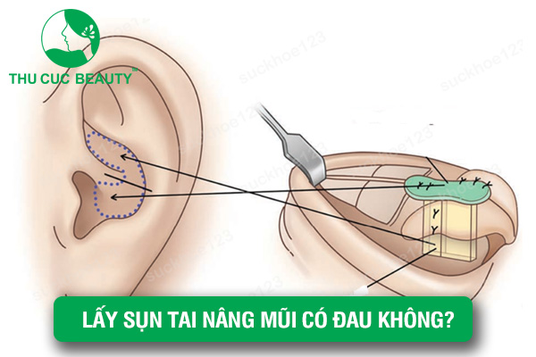 Lấy sụn tai nâng mũi có đau không? - Thu Cúc Sài Gòn