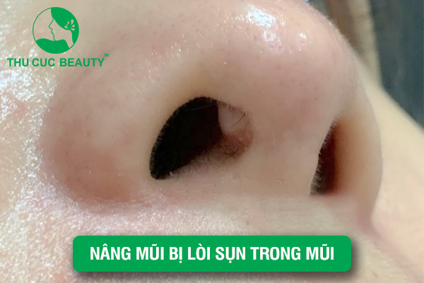 Nâng mũi bị lòi sụn trong mũi - Thu Cúc Sài Gòn