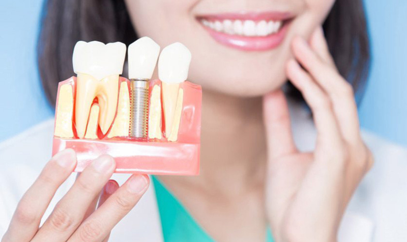 Cấu tạo răng Implant gồm những gì? Cách chọn trụ implant phù hợp