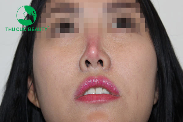 Nâng mũi bị đỏ đầu mũi có sao không? - Bệnh viện Thẩm mỹ Thu Cúc Sài Gòn