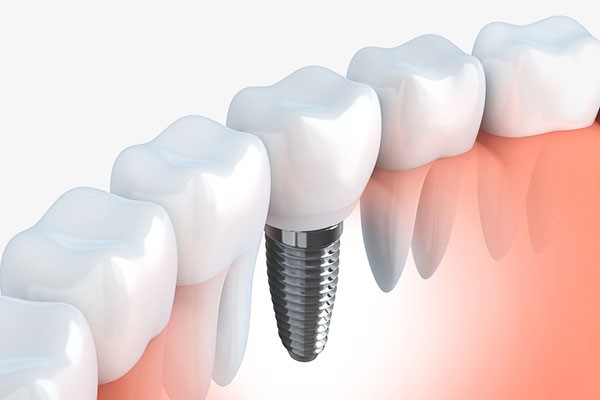 Thời gian làm răng Implant mất bao lâu? 8 yếu tố quyết định