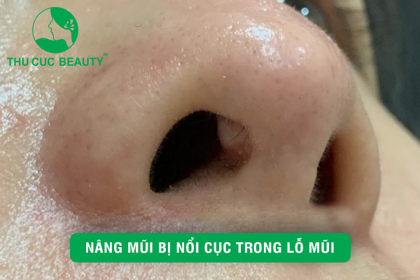 Nâng mũi bị nổi cục trong lỗ mũi - Thu Cúc Sài Gòn