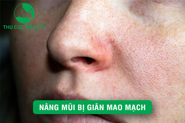 Nâng mũi bị giãn mao mạch - Cách xử lý an toàn