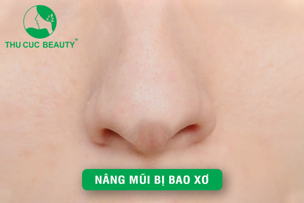 Nâng mũi bị bao xơ là bị làm sao ? Có nguy hiểm không?