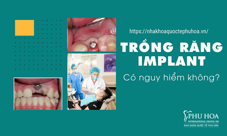 Răng Implant Có Tốt Không? Có nên làm răng Implant? Biến chứng và lưu ý