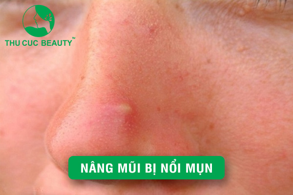Nâng mũi bị nổi mụn - Nguyên nhân và cách xử lý