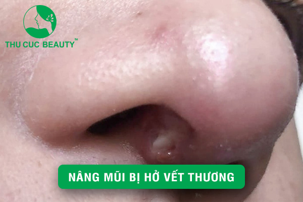 Xử lý tình trạng nâng mũi bị hở vết thương an toàn