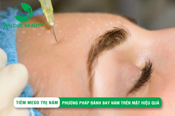 Tiêm Meso trị nám là gì? Ưu điểm nổi bật của phương pháp