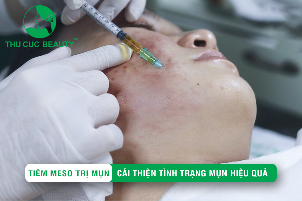 Tiêm Meso trị mụn là gì? Ưu điểm và tác dụng nổi bật