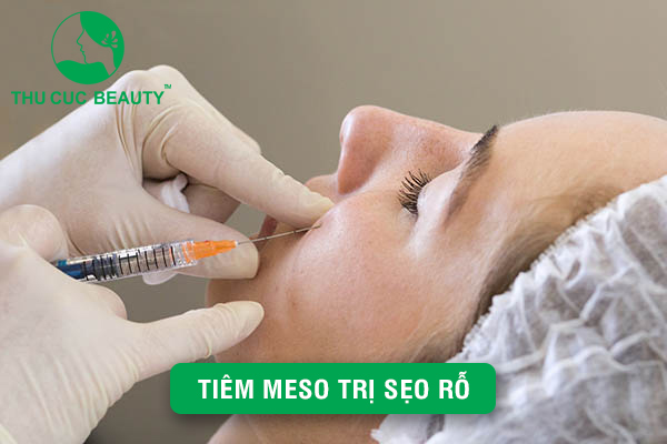 Tiêm Meso trị sẹo rỗ - Giải pháp loại bỏ triệt để sẹo rỗ