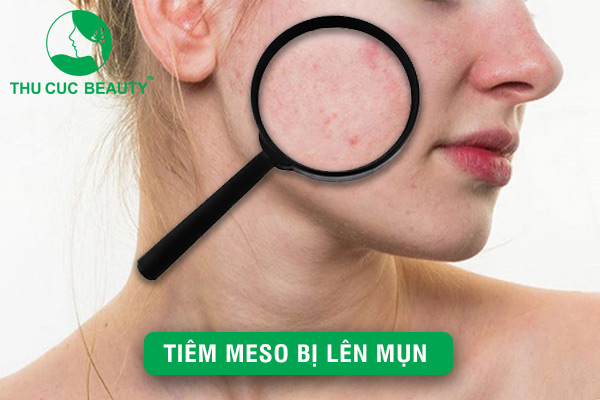 Tiêm Meso bị lên mụn: Cách ngăn ngừa tình trạng hiệu quả