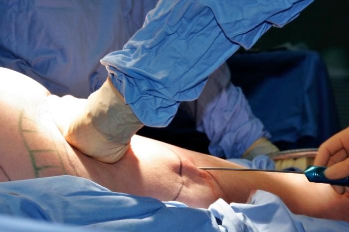 Liposuction and Body Contouring with Cutting-Edge Technology | TechPlanet