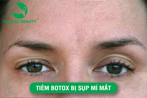 Tiêm Botox bị sụp mí mắt: Cách xử lý tình trạng triệt để