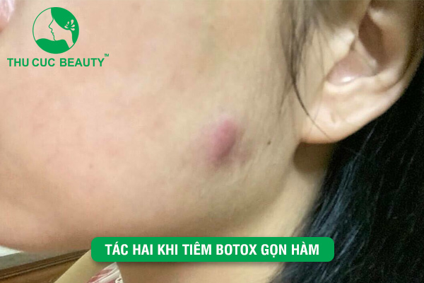 Tác hại khi tiêm Botox gọn hàm tại cơ sở kém uy tín