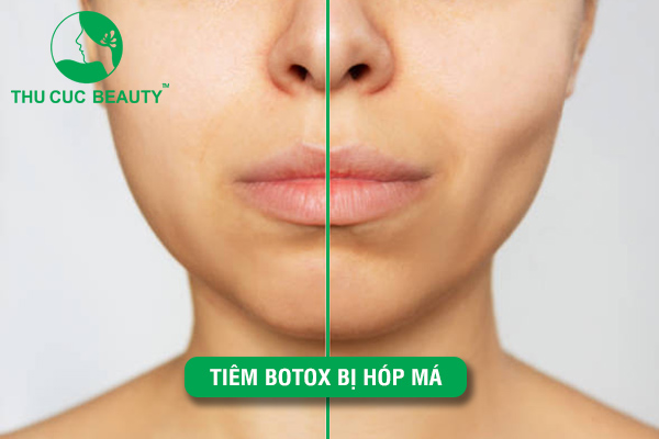 Tiêm Botox bị hóp má: Cách xử lý tình trạng an toàn