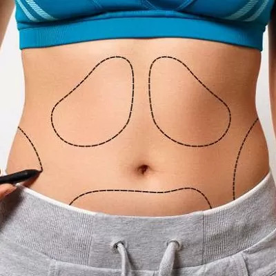 Navigating Tummy Tuck Costs in Dubai & Abu Dhabi