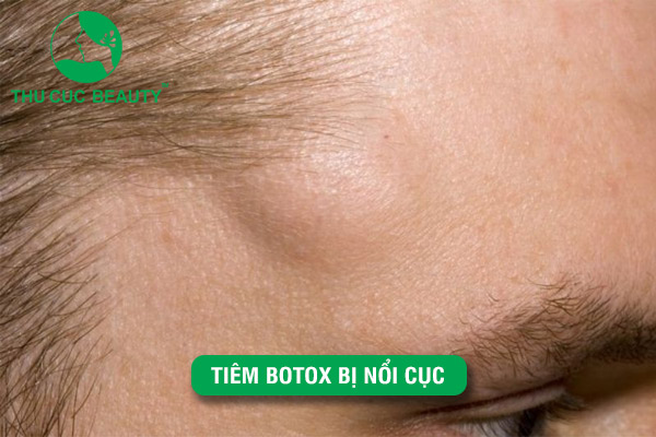 Tiêm Botox bị nổi cục: Nguyên nhân và cách khắc phục