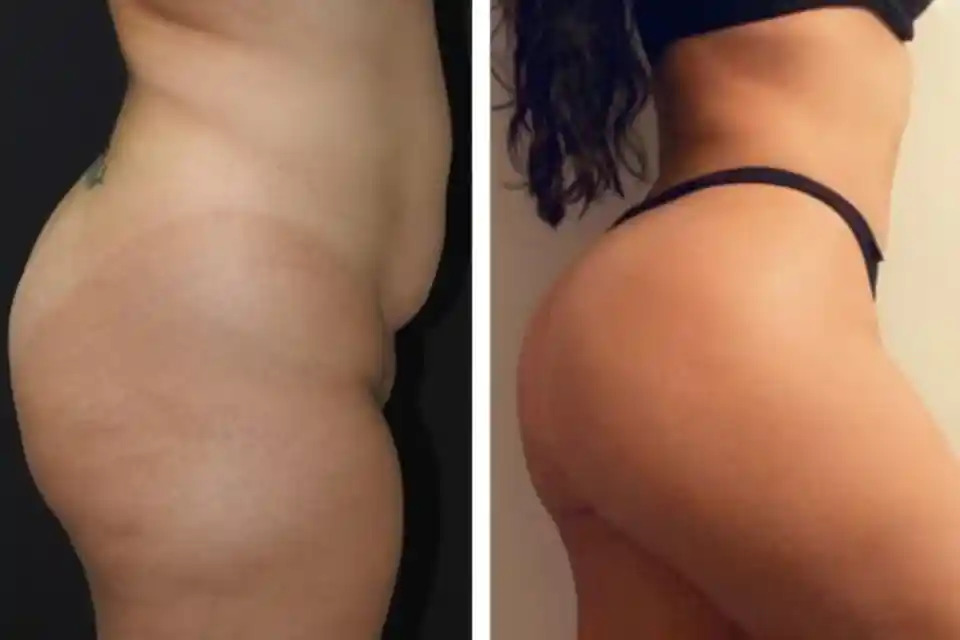 Cutting-Edge Liposuction Tech in Dubai: Beyond the Hype | TechPlanet