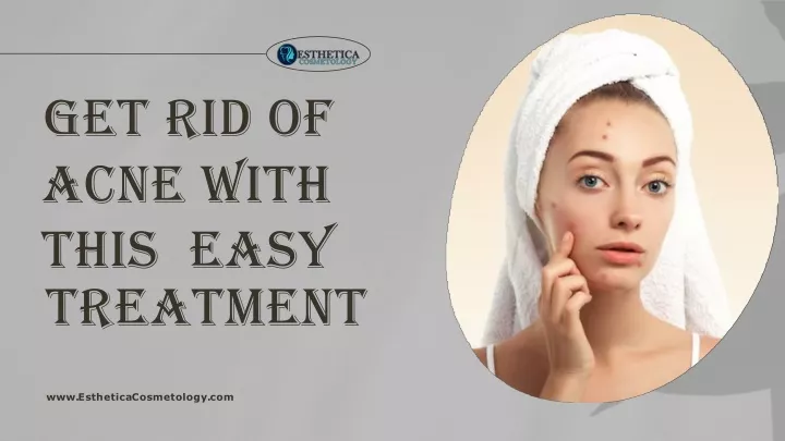 PPT - Get Rid Of Acne With This Easy Treatment PowerPoint Presentation - ID:12874582