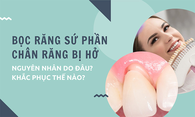 BỊ HỞ CHÂN RĂNG SAU KHI BỌC RĂNG SỨ - Reviewnhakhoa