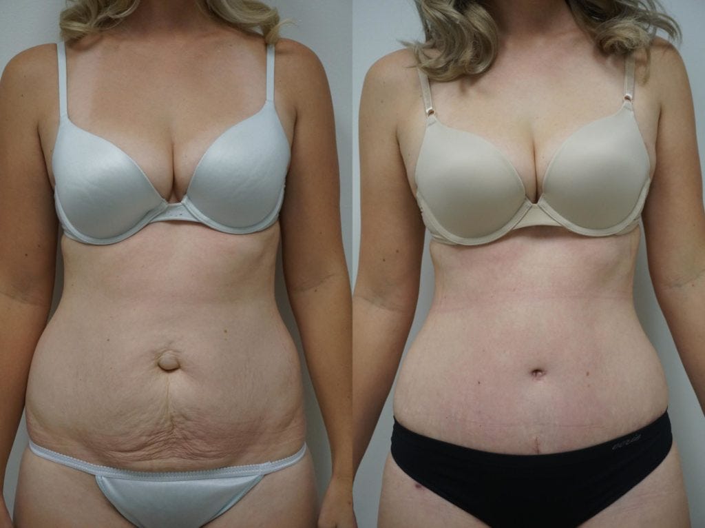 Affordable Tummy Tuck Surgery in Dubai: Achieve Your Dream Body | by Perfect Doctors Clinic | Jan, 2024 | Medium