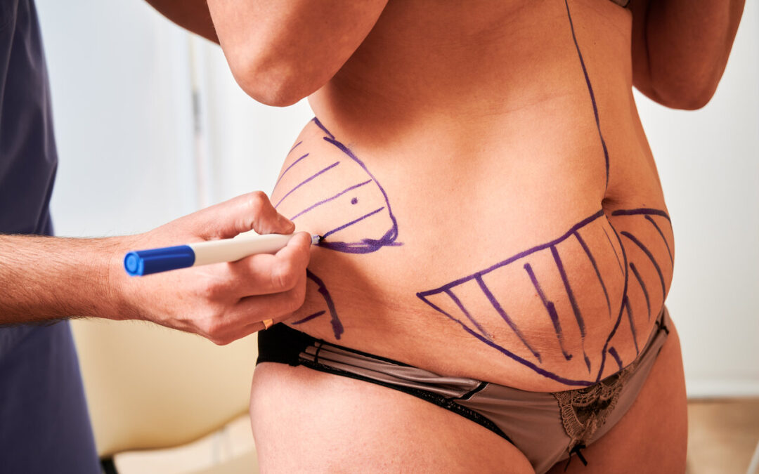 Liposuction and Beyond: Orchestrating a Complete Body Transformation | TheAmberPost