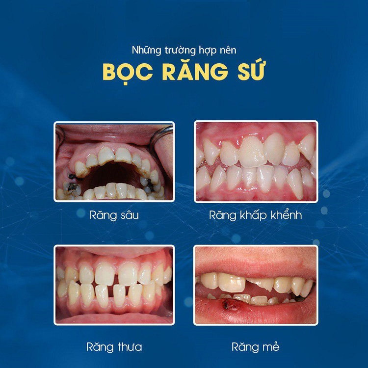 Nên bọc răng sứ khi nào?