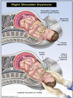 Exploring Shoulder Dystocia Complications in Fetal Health - AtoAllinks