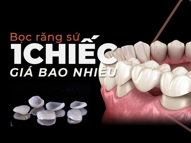 BẢNG GIÁ CÁC LOẠI RĂNG SỨ HIỆN NÀY TRÊN THỊ TRƯỜNG