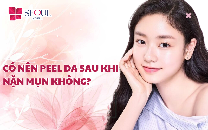 Có nên peel da sau khi nặn mụn? Bao lâu peel da được?