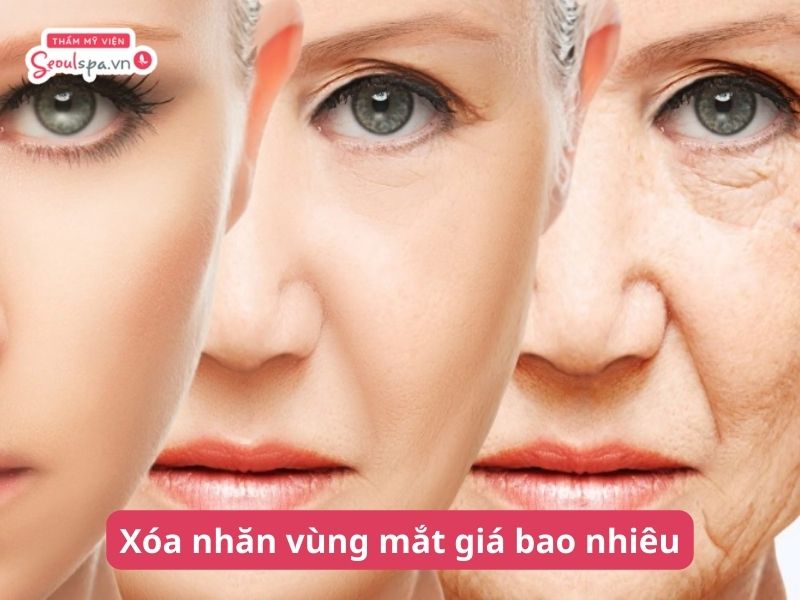 Xóa nhăn vùng mắt giá bao nhiêu? Bảng giá mới nhất 02/2024