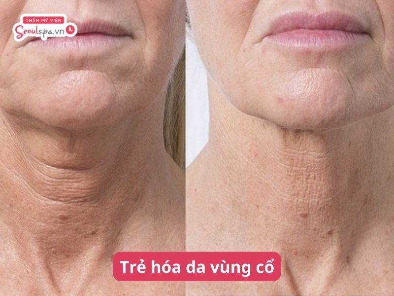 Các phương pháp trẻ hóa da vùng cổ hiệu quả và an toàn