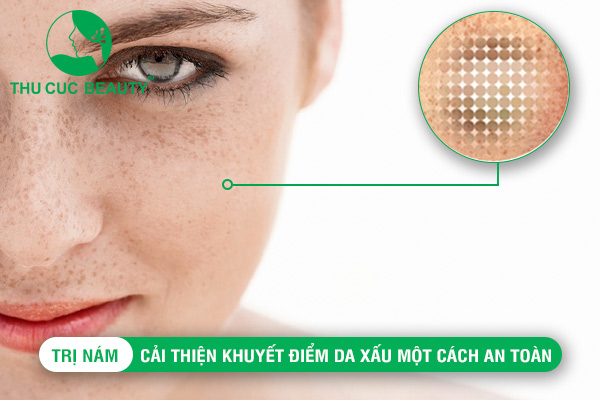 Trị nám - Cải thiện khuyết điểm da xấu một cách